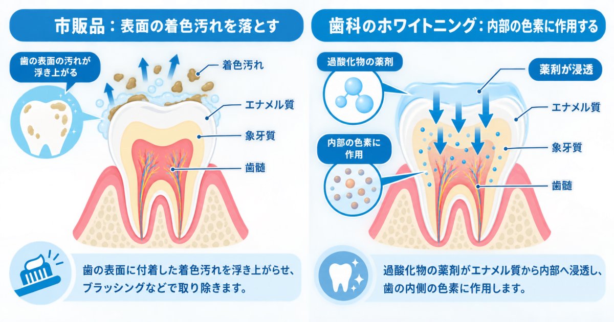 市販品とクリニックのホワイトニングは作用の仕組みと目指せる色の変化が違う